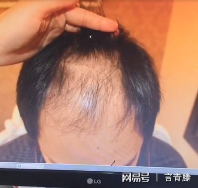 揭秘毛发种植技术：哪种方法才是你的最佳选择？