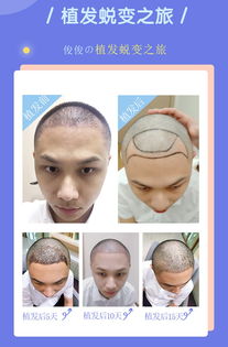 《揭秘毛发种植：如何找到最优质的医疗服务？》