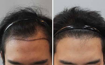 《揭秘毛发种植新趋势：哪种技术更胜一筹？》