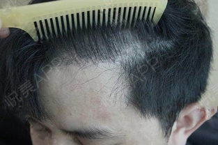 揭秘毛发种植技术：如何重拾自然秀发？