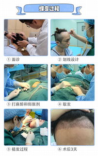 揭秘种植发际线技术：重塑自然之美，你准备好了吗？