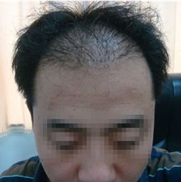 揭秘植发技术新篇章：如何选择最适合你的方法？
