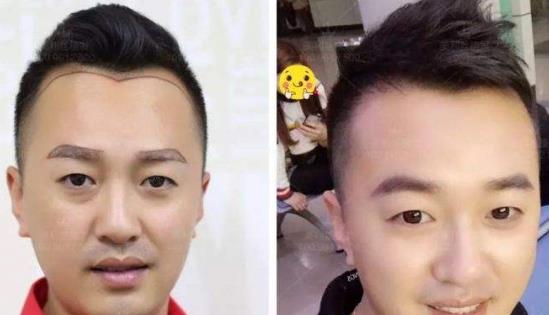 眉目传情，重塑自然——眉毛毛发种植技术解析