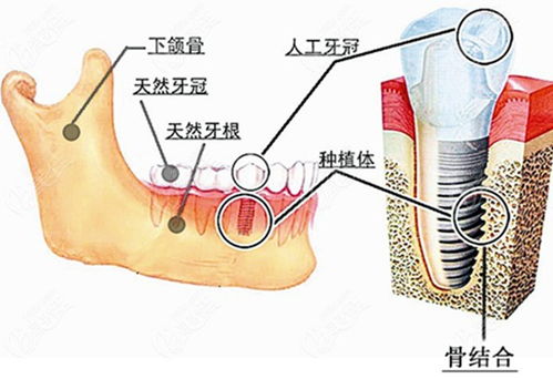 种植牙技术：重塑微笑的艺术——揭秘现代口腔修复新趋势