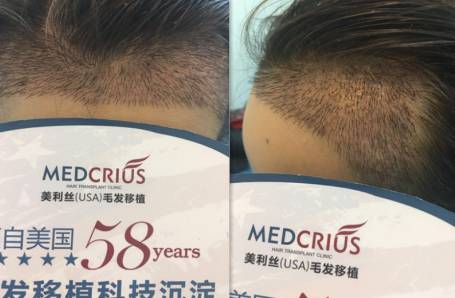 毛发种植技术：揭秘现代美容的秘密武器