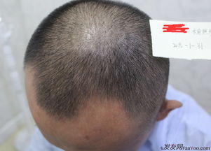 揭秘自学头发种植技术：掌握这门“植”得自豪的技艺