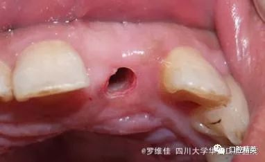 《革新口腔种植术：不翻瓣技术引领未来，揭秘种植牙新趋势！》
