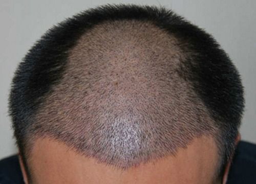 毛发种植技术靠谱吗？揭秘行业现状与未来趋势