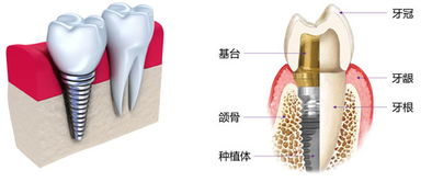 牙齿种植新时代：揭秘口腔医学的革新之路