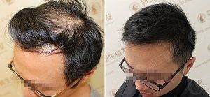 揭秘毛发种植：技术革新下的植发选择指南