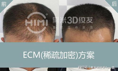 【揭秘】汕头头发种植技术：如何让脱发难题迎刃而解？