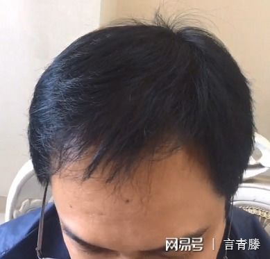 揭秘头发加密种植技术：革新之路，你准备好了吗？