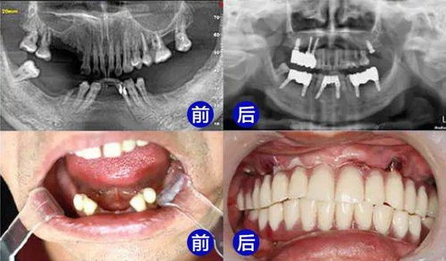 广州微创技术种植牙：革新口腔修复新篇章
