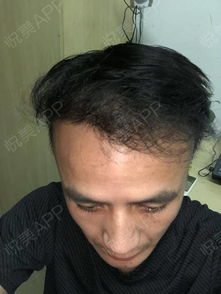 《揭秘毛发种植：一场重塑头发的科技之旅》