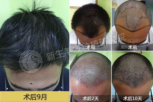 揭秘发际线种植：科技重塑颜值新趋势
