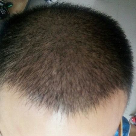 揭秘头发种植技术：一场科技与自然的完美邂逅