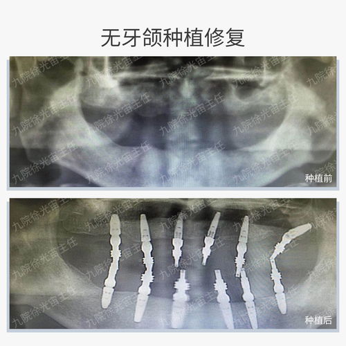 口腔种植骨增量技术：重塑微笑的“秘密武器”